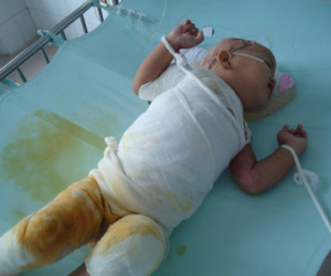 Ngã vào nồi canh nóng, bé gái 17 tháng tuổi nguy kịch
