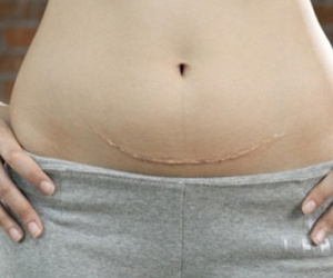3 sự thật về sinh mổ có thể mẹ bầu chưa biết