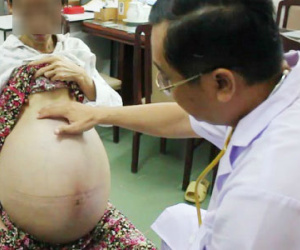 Bụng to hơn bầu 9 tháng hóa ra mang u buồng trứng nặng... 35kg