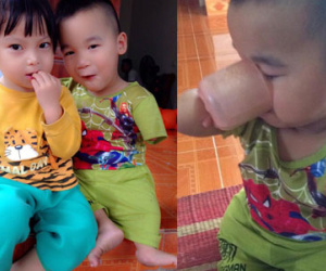 Cậu bé tí hon với đôi tay cụt và bàn chân 3 ngón lẫm chẫm đi khiến các mẹ rơi nước mắt