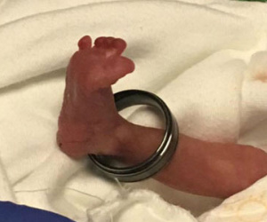 Em bé sinh non có bàn chân lọt thỏm trong nhẫn