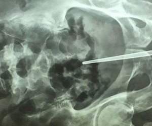 Chàng trai dại dột bị mắc kẹt đũa trong "của quý"