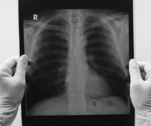 Vì sao không hút thuốc vẫn bị ung thư phổi?