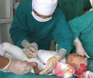 Mẹ sơ sẩy, con 14 tháng tuổi ngã vào nồi canh vừa sôi gây bỏng nặng