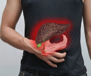 5 dấu hiệu tố bạn bị gan nhiễm mỡ