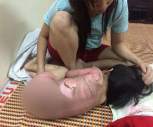 Em bé bị bỏng toàn thân khi tắm và lời cảnh tỉnh cho bố mẹ