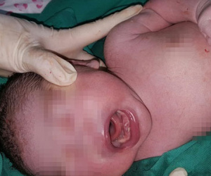 TP.HCM: Một bé gái mới sinh đã mọc... 2 răng cửa