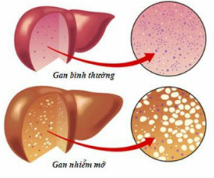 Cảnh giác dấu hiệu bệnh gan nhiễm mỡ