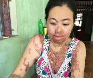 Hình ảnh ngày ấy - bây giờ của người phụ nữ là nạn nhân của vụ tạt axit chấn động giữa ban ngày