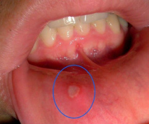 Loét miệng có cần bổ sung vitamin?