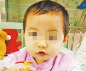Bé gái 2 tuổi bị đũa cắm vào mắt, chạm tới sọ khi đang ăn cơm