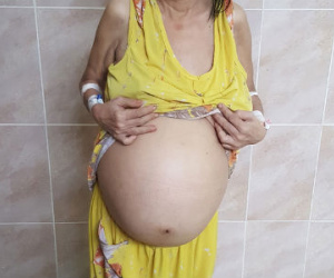 Cứu sống một phụ nữ mang khối u trong tử cung nặng đến…12kg