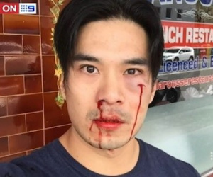 Diễn viên gốc Việt bị đánh mẻ răng, chảy máu mũi ở Australia