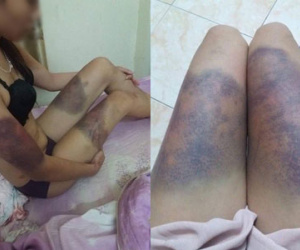 Hà Nội: Cô gái trẻ “tố” bị bạn trai ghen tuông, đánh đập thâm tím hết cả người