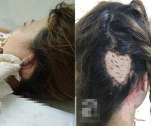 Chị em đi làm tóc cuối năm hãy cẩn thận: đã có người bị lột da đầu, người suýt mất tai