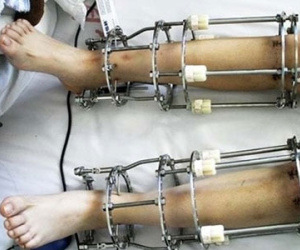 Bị chê “nấm lùn”, cô gái trẻ quyết định mạo hiểm phẫu thuật kéo dài chân