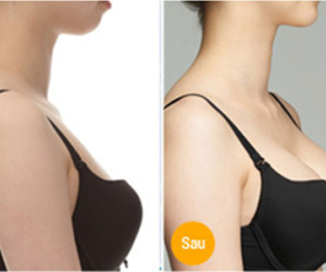 Bác sĩ phẫu thuật nâng ngực cho bạn như thế nào