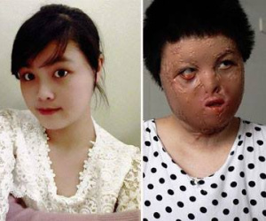 Cô gái bị chồng thiêu sống đúng mùng 2 Tết năm ngoái vẫn đang trên hành trình tìm lại hình hài