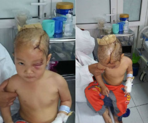 Thanh Hóa: Bé gái 3 tuổi bị chó hoang tấn công suýt mất mạng