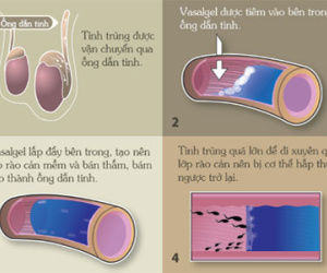 Loại thuốc giúp đàn ông tránh thai trong 2 năm