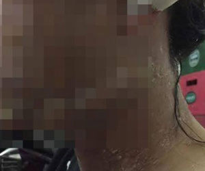 Tạt nguyên nồi nước sôi vào mặt bà bầu 5 tháng chỉ vì tranh chấp mặt bằng buôn bán
