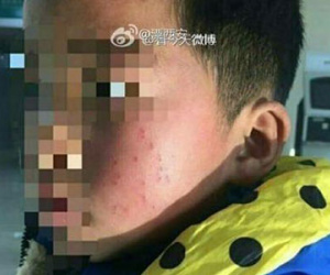 Hiệu trưởng trường tiểu học dùng bút bi đâm 17 nhát vào mặt học sinh