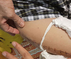 Phụ huynh có con bị gãy chân tại trường: Báo cáo của hiệu trưởng là dối trá