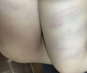 Sa thải giáo viên dùng đũa đánh thâm tím hai chân bé gái