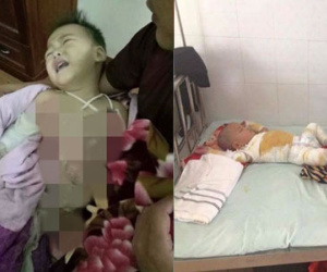 Mẹ bất cẩn, con trai 2 tuổi ngã vào nồi nước sôi bỏng toàn thân