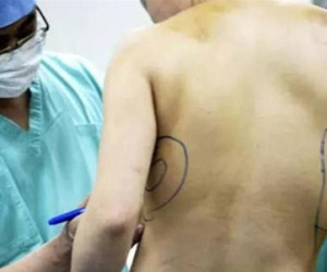 Sau 10 năm thẩm mỹ, người phụ nữ cay đắng gỡ miếng độn ngực đang dần trôi về sau lưng