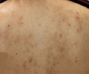 Vì sao nhiều người hay bị mụn trứng cá ở lưng và ngực?