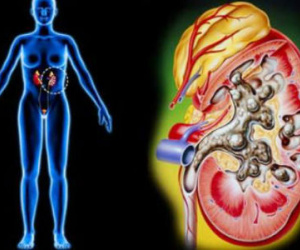Dấu hiệu cảnh báo viêm cầu thận cấp