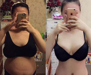 Cắt phăng 2 tảng mỡ bụng để giảm cân có nguy hiểm?