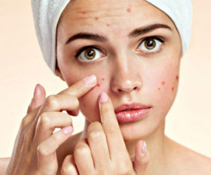 Bị trứng cá bôi thuốc gì?