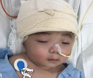 Một ngày sau cuộc tiểu phẫu, em bé não úng thuỷ Phạm Đức Lộc đã biết mở mắt, cử động tay chân