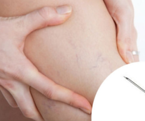Bị suy tĩnh mạch không nên chích lể nặn máu