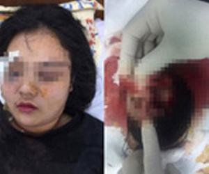 Vụ cô gái bị 20 thanh niên đánh dã man vì tố giác trộm xe: Mắt trái nạn nhân có nguy cơ mù hoàn toàn