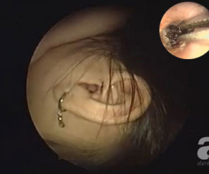 Ngủ trưa, bé gái 9 tuổi bị gián chui vào lỗ tai