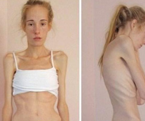 Cô gái "gầy xiêu gầy đổ", suýt chết vì chứng biếng ăn năm xưa giờ ra sao?