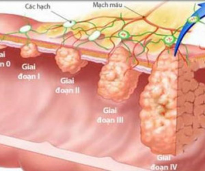 Chuyên gia Malaysia: 3 cách phát hiện sớm, loại bỏ ung thư đại trực tràng từ "trứng nước"
