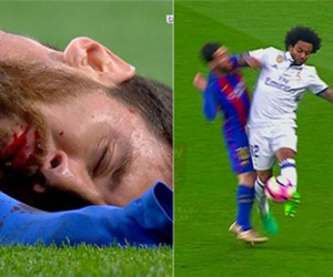 Messi đổ máu, gãy răng khi va chạm với Marcelo