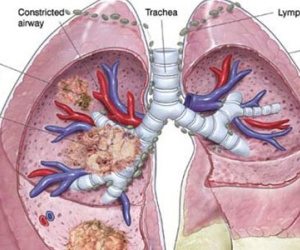 Căn bệnh ung thư ám ảnh, 1 phút có 3 người chết