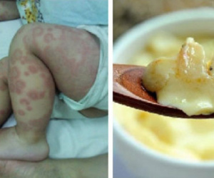 Thấy cháu há miệng nên bà cho ăn vài thìa trứng, ít phút sau phải nhập viện khẩn cấp