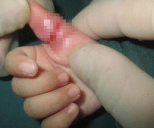 Mẹ trẻ hối hận vì thói quen thả tóc khiến con gái 5 tháng suýt phải cắt bỏ ngón tay