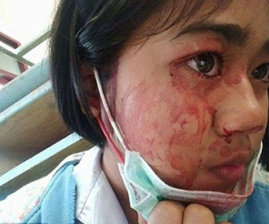 Mắc quái bệnh, bé gái cứ đau đầu căng thẳng là đổ mồ hôi máu