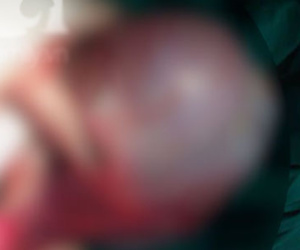 Hà Nội: Mổ lấy khối u buồng trứng nặng 1,8kg cho cô gái 20 tuổi