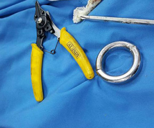 Đeo nhẫn cho “của quý”, 2 ngày trời vật lộn không gỡ được ra