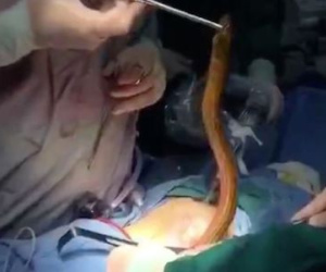 Bác sĩ kéo lươn khổng lồ ra khỏi bụng bệnh nhân