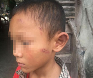 Bé trai 5 tuổi bị dì ruột bạo hành dã man