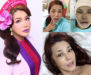 Cindy Thái Tài tiếp tục sửa mũi lần 5, "đập đi xây lại" toàn bộ mặt
